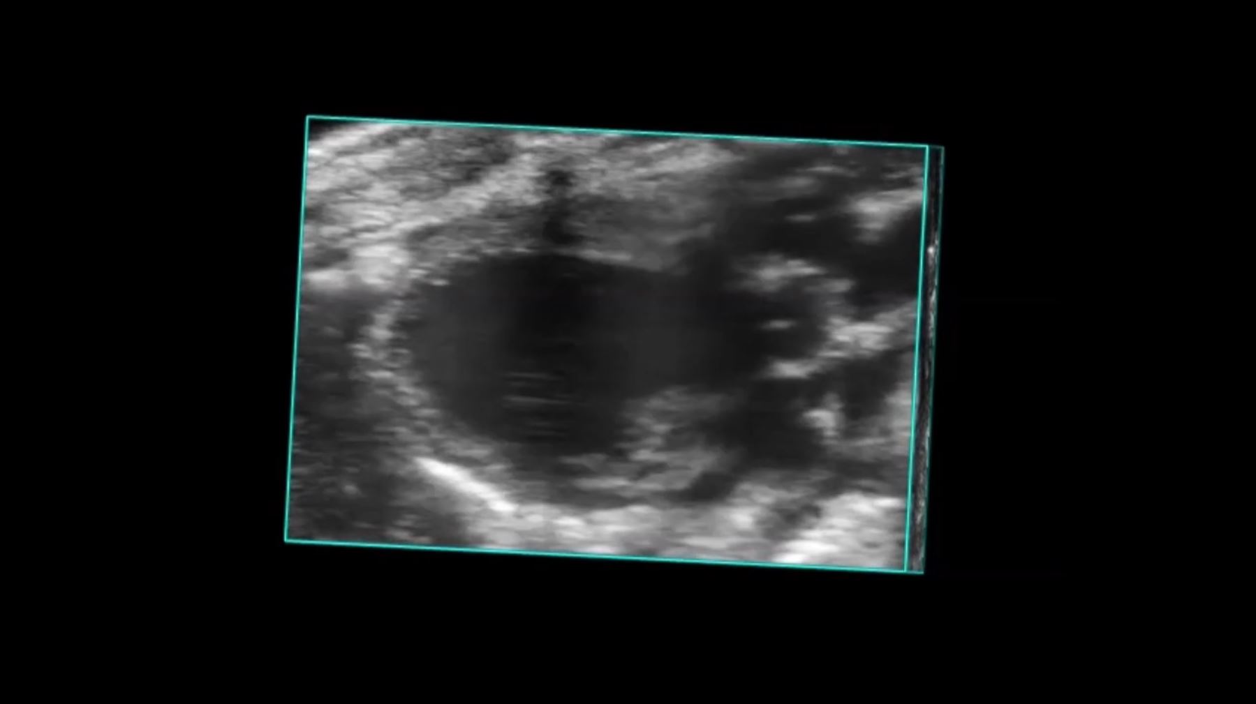 Parasternal Long Axis View of Myocardial Infarct in 4D