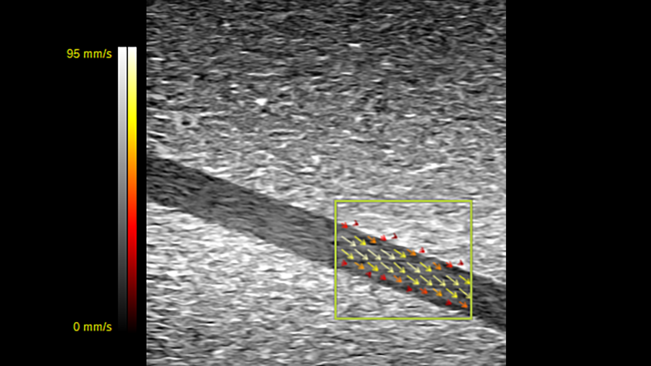 Vector Flow Imaging showcasing flow through a phantom indicated in a yellow outlined box.