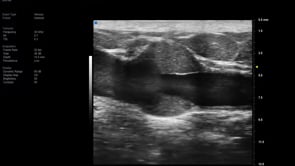 UHF 48 MHz - Arm Vein with Valve