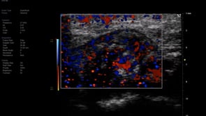 Vevo MD UHF 48 Post tooth extraction  palpable mass on a 40 Yr old male