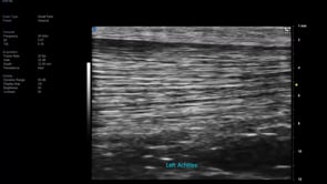Vevo MD UHF 48 Lt Achilles Tendon with each collagenous fibre clearly delineated