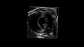 Cardiac Hypertrophy in 4D