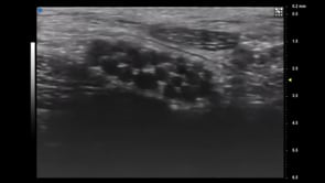Vevo MD UHF 70 Median Nerve - Cross section of the nerve bundle