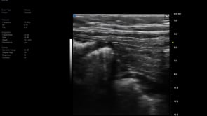 Pediatric Bowel