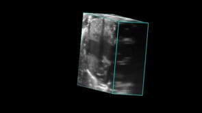 Left-Ventricular Myocardial Hypertrophy in 4D