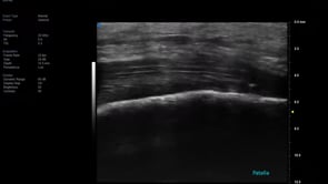 UHF 48 MHz - Patellar Tendon