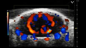 Vasculature in the Brain during Ischemic Stroke