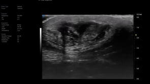 UHF 70 MHz - Superficial Wound R/O Abscess