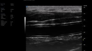 UHF 70 MHz - Radial Artery