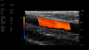 UHF 48 MHz - Radial Artery