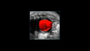 4D Left Ventricular Volume Overlay