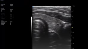 Trx Pediatric Esophagus