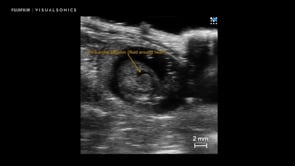 Pericardial Effusion - Fluid around Heart in Spina Bifida Rat Model