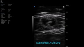 Vevo MD UHF 48 Submental LN- Cortex and fatty hilum