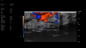 Vevo MD UHF 70 Superficial 2 mm Hemangioma with colour flow