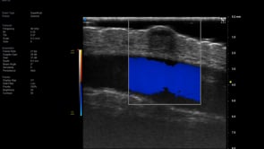 Sag Superficial Mass with underlying vein and colour flow