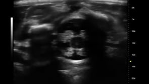 2 Month old Neonate Spine