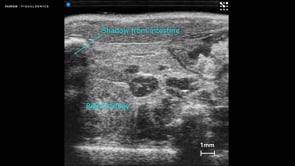 Kidney with shadow