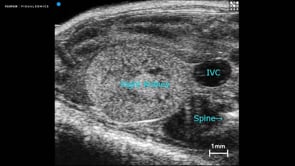 Right Kidney