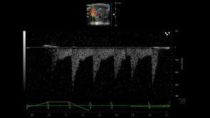 PW Doppler of Renal Artery Flow