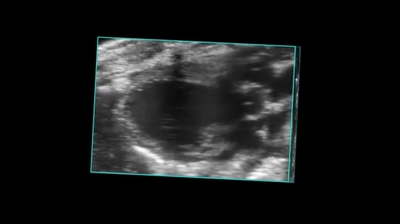 Parasternal Long Axis View of Myocardial Infarct in 4D