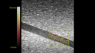 Vector Flow Imaging showcasing flow through a phantom indicated in a yellow outlined box.