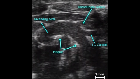 Atherosclerotic plaque in a mouse aortic arch