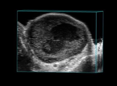 Breast tumor in 3D