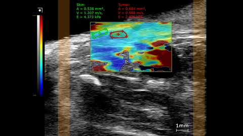 Subcutaneous prostate tumor, SWE mode stiffness map showing elastography measurements comparing the tumor to skin
