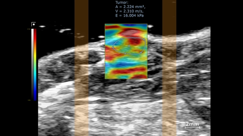 SWE mode overlay showing stiffness map in the tumor region