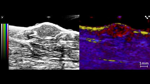 Unmixing from a PA Spectro scan showing lipid (yellow) in the skin layer, and oxy/deoxyhemoglobin (red/blue) in the tumor and surrounding tissue. Collagen (green) was included in the unmixing, but no noticeable signal above background
