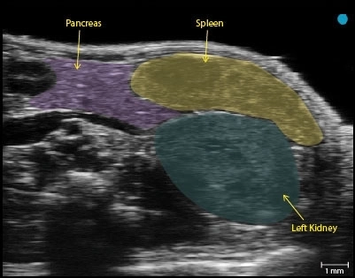 Healthy pancreas Tail.jpg