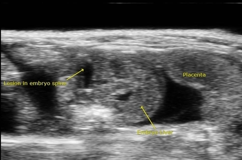 Lesion in Embryo Spine.jpg