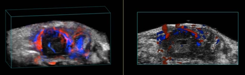 Ortho-panc-tumor-color-3D-rend.jpg