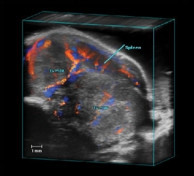 Pancreatic Tumor Color Doppler 3D.jpg