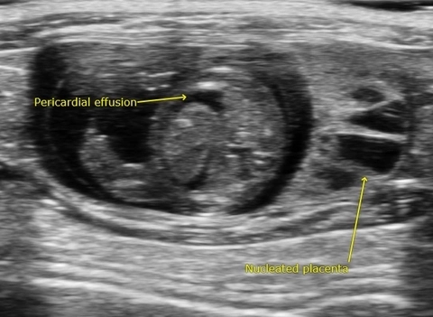 Pericardial Effusion.jpg