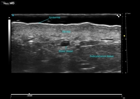 UHF70 - High Resolution Ultrasound Dermal Imaging.png