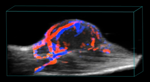 Tumor-Color-3D.jpg