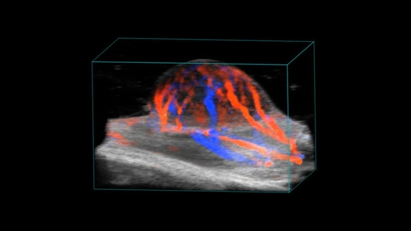 Tumor-Colour-Doppler