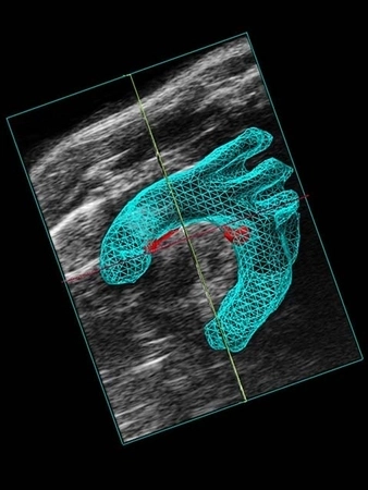 3D Volume of Aortic Arch  with Plaque.jpg