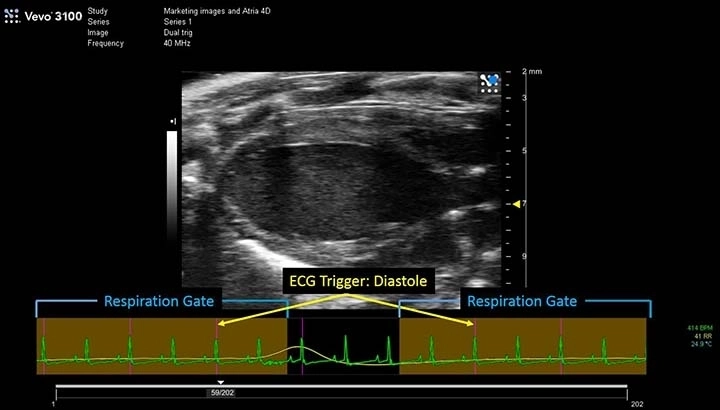 Dual Trigger diastole.jpg