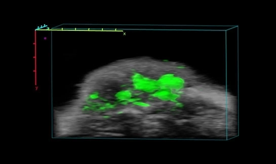 Oncology - ICG localization in tumor.jpeg