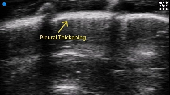 Rat Pleural Thickening.jpg