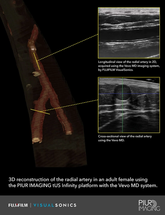 3D Ultrasound Imaging 3D Ultrasound Imaging