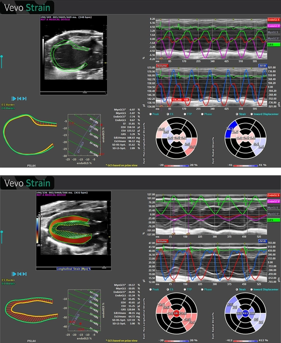 See the difference between normal heart (bottom) and infarcted heart (top). Vevo Strain 2.0 Analysis Screens showing normal heart and infarcted heart.