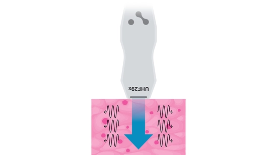 Shear wave elastography induces shear waves via ultrasound push pulse(s). A UHF29x transducer sending shear waves via ultrasound push pulse(s).